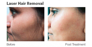 Laser Treatments