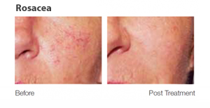 Laser Treatments